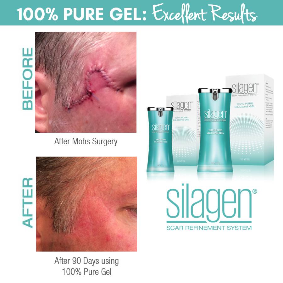 Scar Refinement System - 100% Pure Silicone Gel for Scars